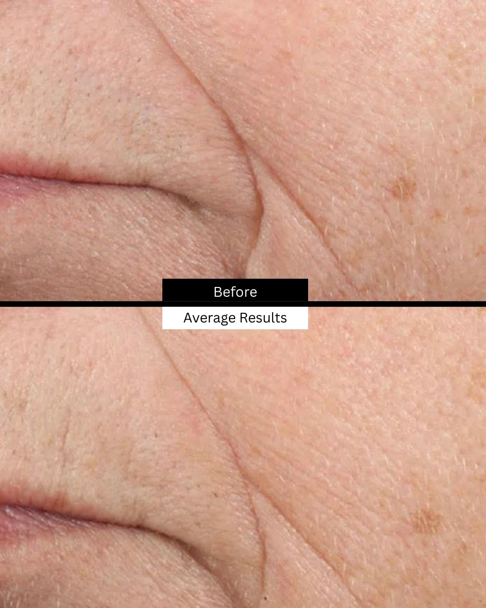triple-lipid-before-after